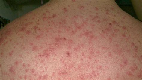 Erythema multiforme: Pictures, causes, treatment, and more