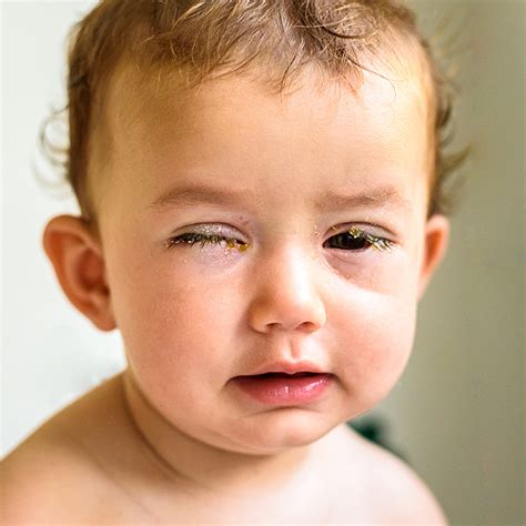 Children's Eye Infections - Kids Eye Gear