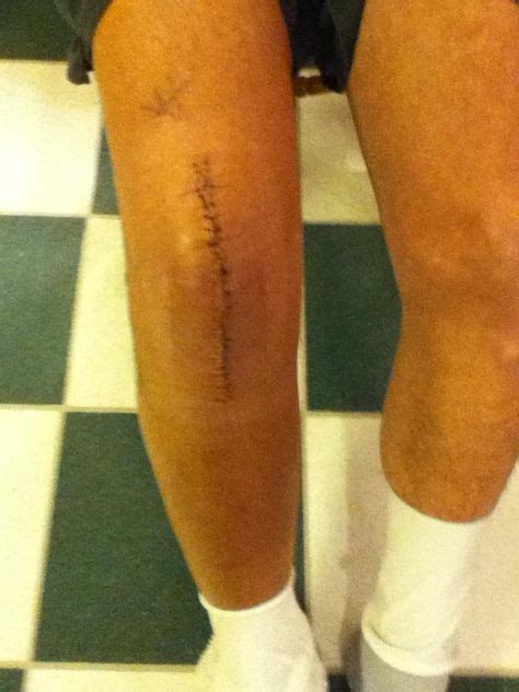 Knee Replacement Scars