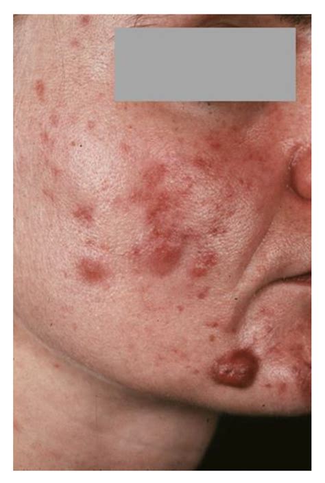 Dermato | Free Full-Text | Association of Acne Tarda with Endocrinological Disorders