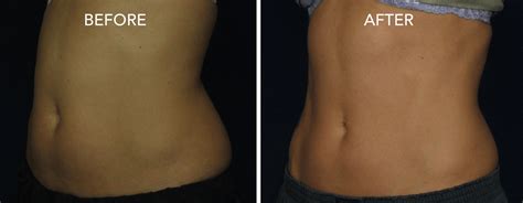 Coolsculpting: Before/After Photos | DermMedica