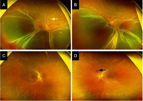 Bilateral exudative retinal detachment and choroidopathy as the ...