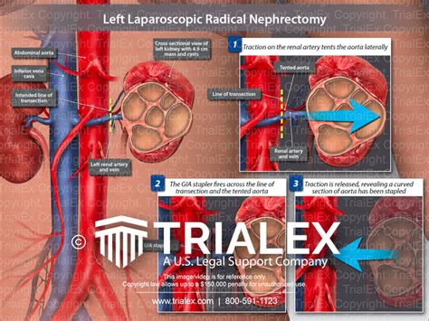 Left Laparoscopic Radical Nephrectomy - TrialExhibits Inc.