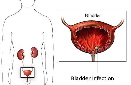 Bladder Infection Symptoms