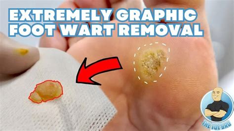 Plantar Wart After Removal