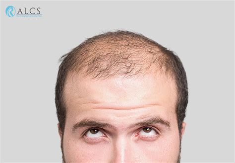 FUT Hair Transplant – 3 Most Important Things You Need to Know - ALCS - Cosmetic Surgery & Hair ...