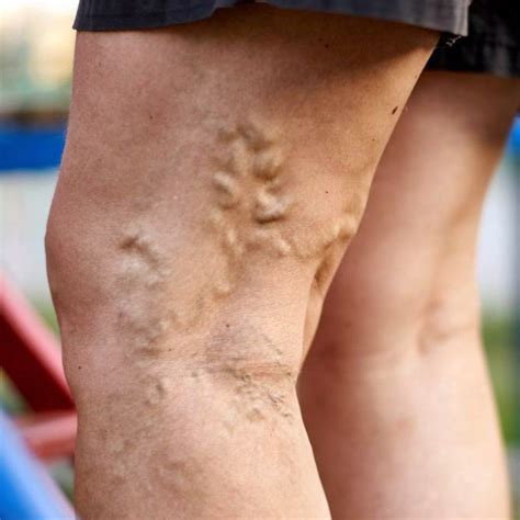 Varicose veins cause and risk factors | Symptoms of varicose veins | AngioLife®