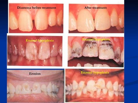 Introduction to fixed prosthodontics