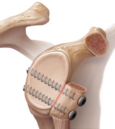 Latarjet for shoulder instability | Orthopaedic shoulder surgeon Perth