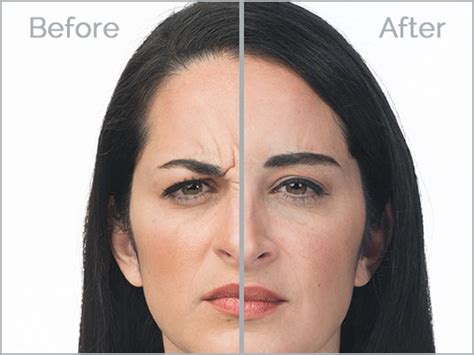 Botox | Best Prices | - Better U Medical Spa | Englewood, New Jersey