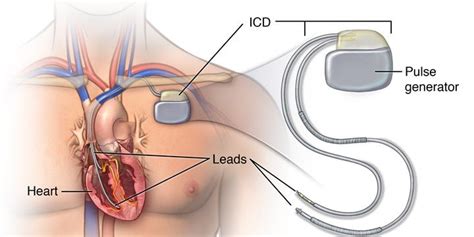 ICD & CRT IMPLANTATION | Dr. Tejas V. Patel | Cardiologist in Ahmedabad | CIMS