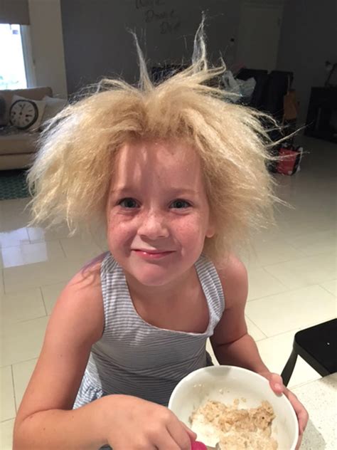 Little girl has uncombable hair syndrome