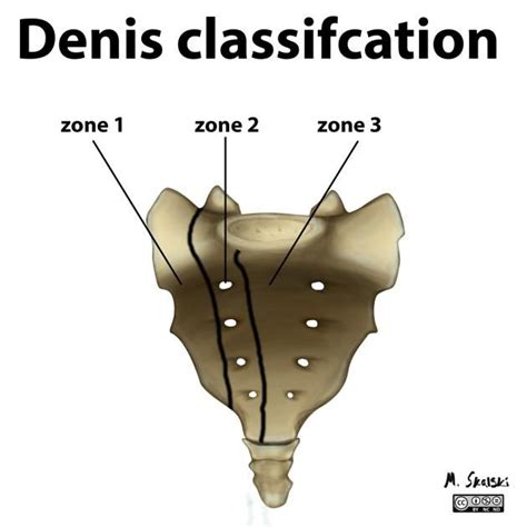 Illustration - Denis classification of sacral fractures | Radiology Case | Radiopaedia.org ...