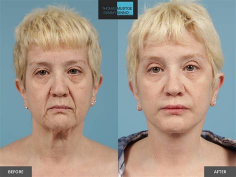 Facelift Before and After Photos Prove Just How Natural Today’s Results Look – TLKM Plastic Surgery