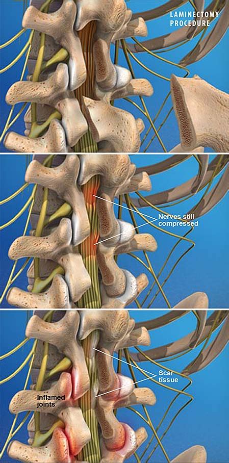 Post-Laminectomy Syndrome | Central Coast Orthopedic Medical Group