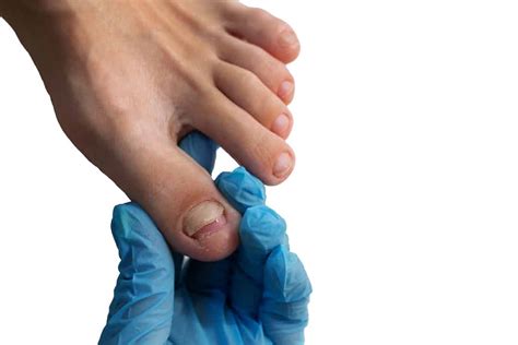 Tinea Unguium (Fungal Nail Infection): Symptoms, Onychomycosis, Causes ...