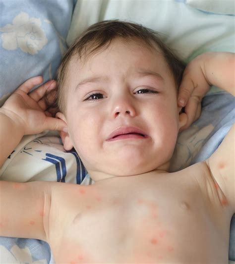 Spider Bites In Toddlers: Facts, Symptoms & Ways To Prevent