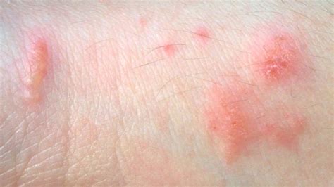 Poison Oak Rash: Pictures and Remedies