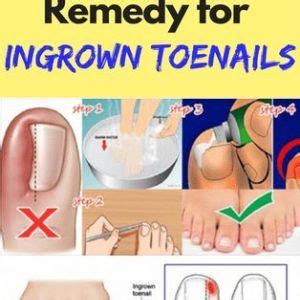 Home Remedies to Get Rid Of Ingrown Toenails | Ingrown toe nail, Home remedies, Remedies