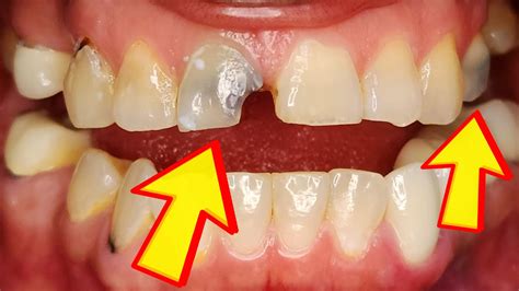 Dentist Explains Every Cause of Gray Teeth & Why Your Tooth is Turning ...