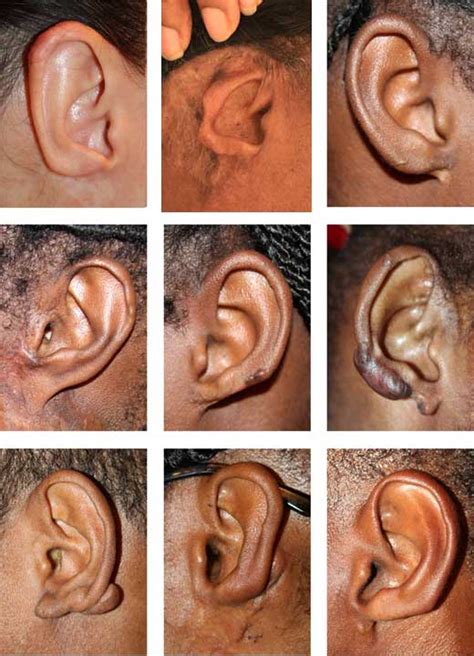 Outcome of Surgery for Ear Keloids