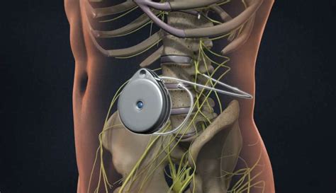 Understanding the Procedure of Intrathecal Drug Pump Implant - Charlton Health - Get Answers to ...