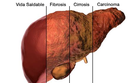 Cancer De Higado Sintomas