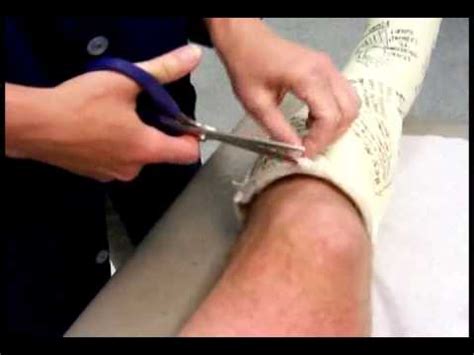 Cast Removal after achillies surgery - YouTube