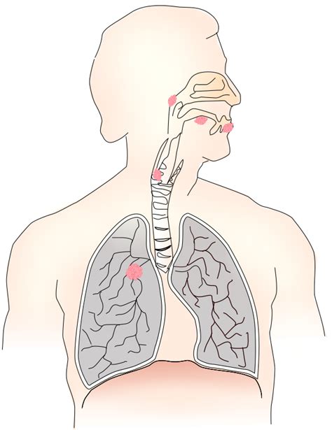 Clipart - Cancer caused by smoking I