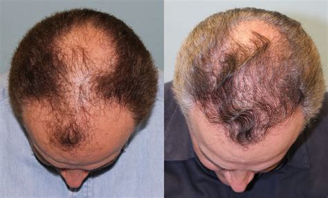Hair Transplant Before And After Photos Plastic Surge - vrogue.co