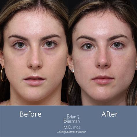 Tear Trough (under eye hollows) Correction | Nasvhille, TN | Tear trough, Face fillers, Dermal ...