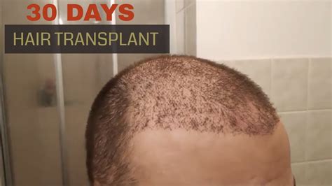 Hair Transplant Post Op Pics - Best Hairstyles Ideas for Women and Men in 2023