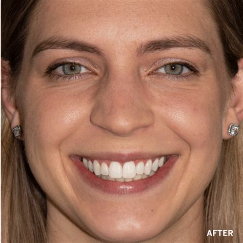 Teeth Whitening Before and After | Supersmile