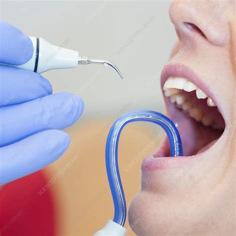 Removing dental tartar - Stock Image - F024/3993 - Science Photo Library