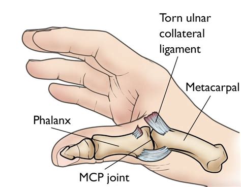 How Do You Treat a Torn UCL Thumb?