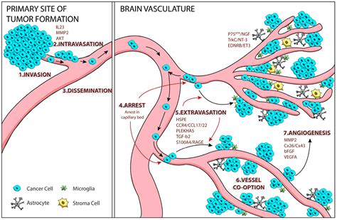 IJMS | Free Full-Text | Melanoma Brain Metastasis: Mechanisms, Models, and Medicine | HTML