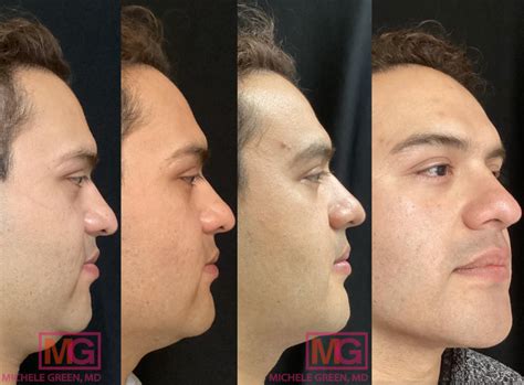 Kybella NYC - Kybella Injections for Double Chin - Dr. Michele Green M.D.