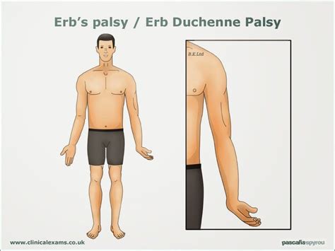 Image result for erb duchenne | Erb palsy, Myofunctional therapy, Brachial