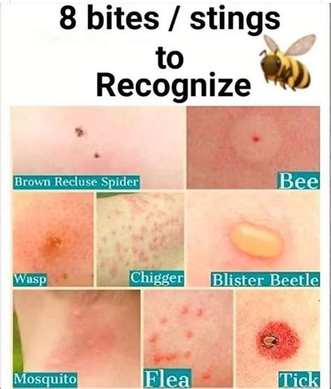 Spider Bite Allergic Reaction Rash - vrogue.co