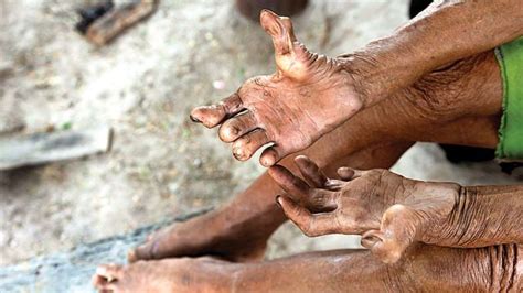 What is leprosy? - Public Health