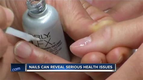 Doctors: Check your nails for dangerous skin cancer - TMJ4 Milwaukee, WI