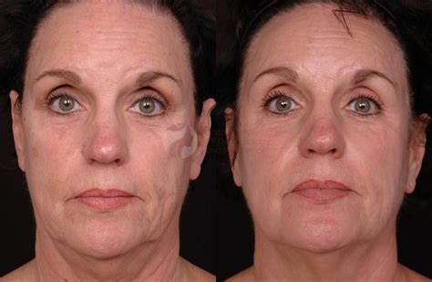 Thermage® Before and After Pictures Case 12 | Plano, Frisco, Dallas ...