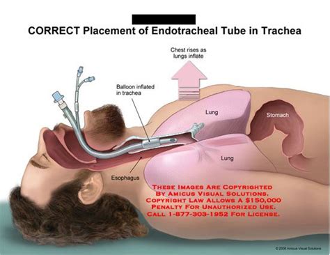 endotracheal tube - Google Search | Medical education, Emergency nursing, Respiratory therapy ...