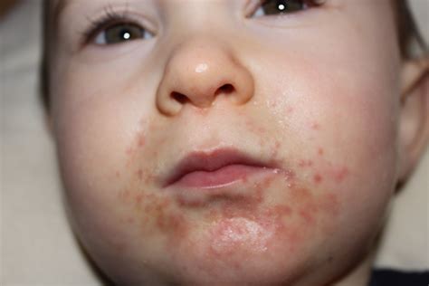 What Can Cause A Rash Around A Child's Mouth | Other Allergies