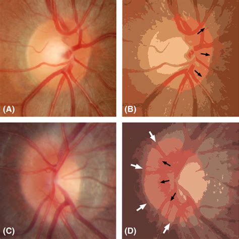 Differentiation between optic disc drusen and optic disc oedema using ...