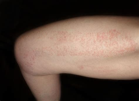 Red Spots on Skin: Causes, Diagnosis, and Treatments