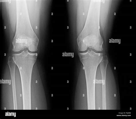 Bone Spur Stock Photos & Bone Spur Stock Images - Alamy