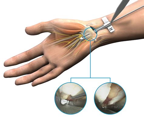 Endoscopic Release For Carpal Tunnel Syndrome - Captions Trendy