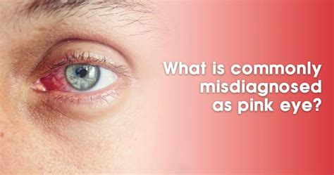 11 Common Conditions Misdiagnosed as Pink Eye