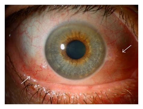 Threatening-to-vision GO. (a) Initial presentation of a patient with... | Download Scientific ...